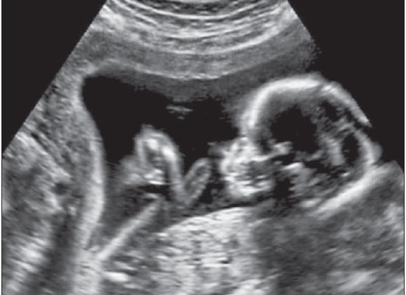 Abortion