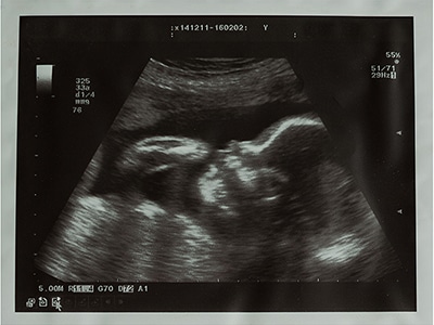 baby ultrasound