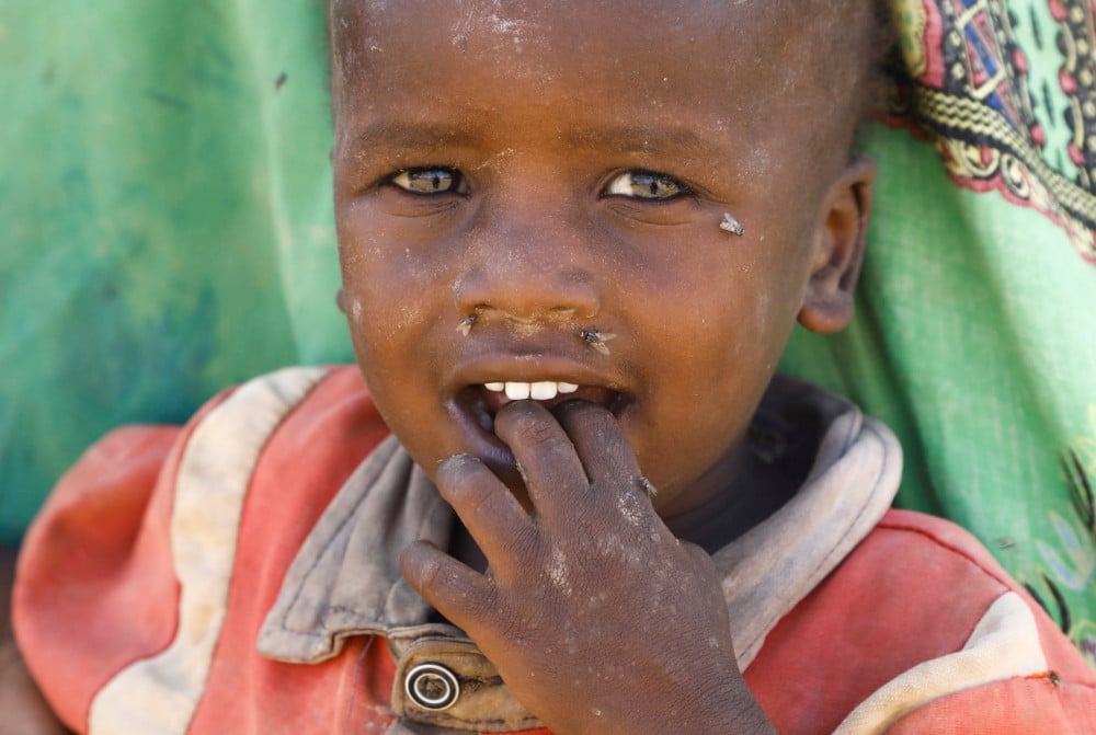 MALNOURISHED CHILD SOMALIA