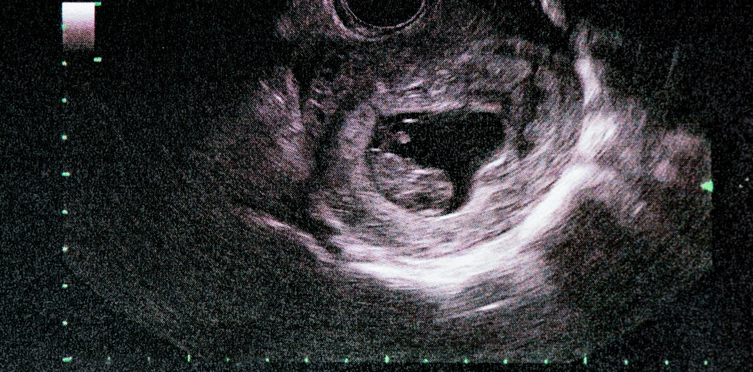 An ultrasound of a human fetus during the 14 week.